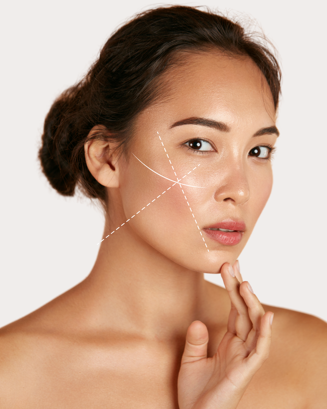 Fillers Amsterdam, Cosmetisch kliniek Amsterdam, fillerbehandeling, lipfiller