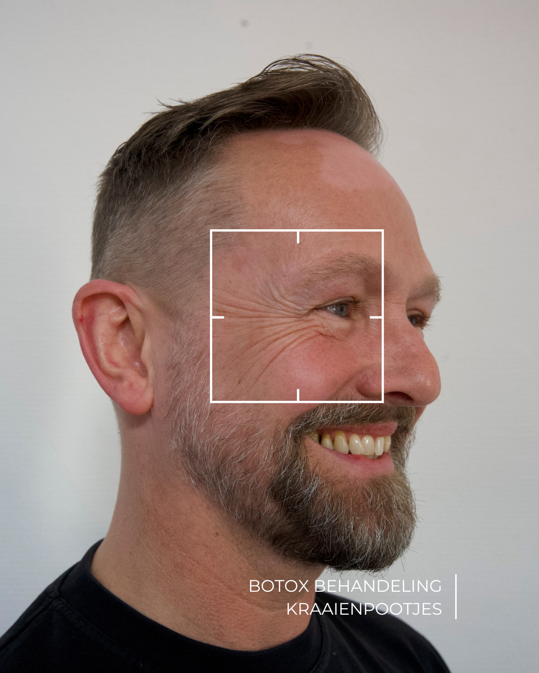 botox kraaienpootjes behandeling voor