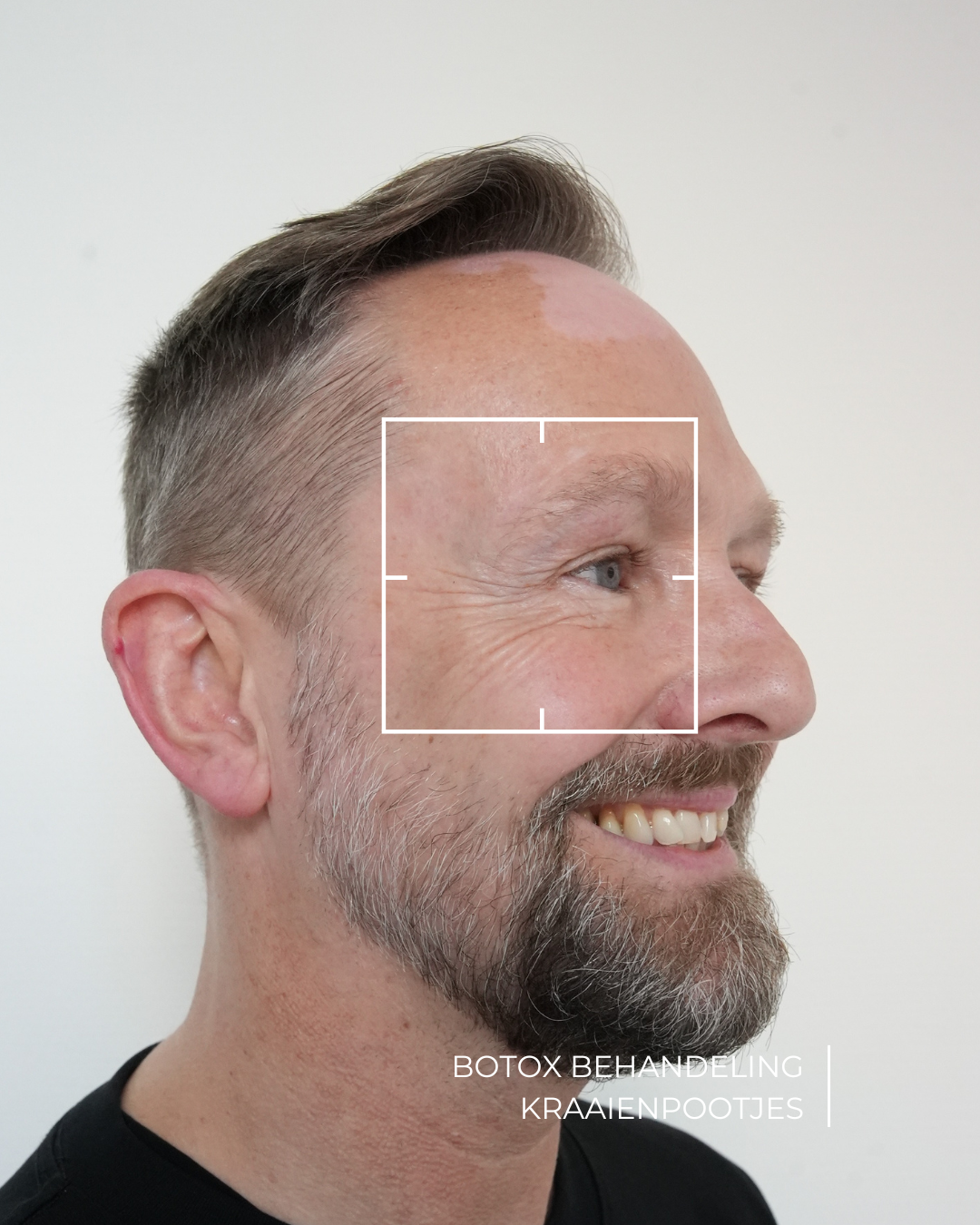 botox kraaienpootjes behandeling na