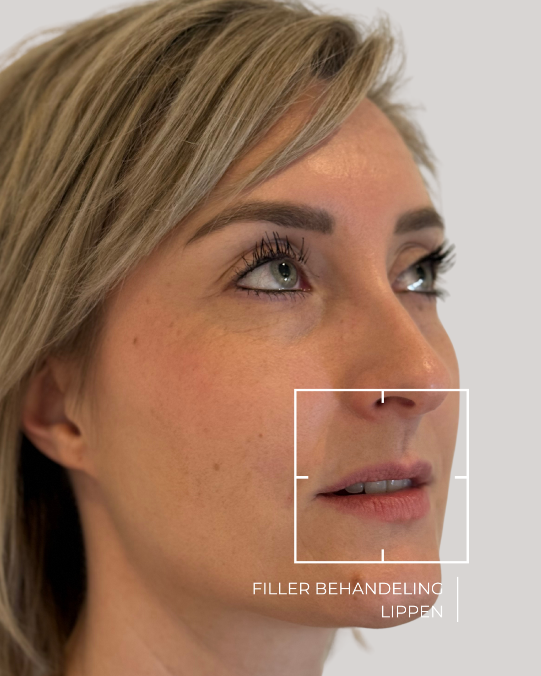 filler behandeling lippen voor