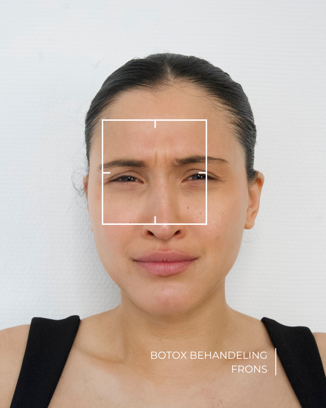 botox frons behandeling voor