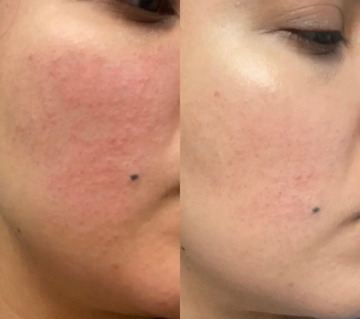 ✨ Our Laser Treatments ✨
• Skin Rejuvenation: Boost collagen, smooth texture & restore glow.
• Pigmentation: Fade sun damage & age spots for even-toned skin.
• Vascular: Reduce redness, veins & capillaries.
• Hair Remo