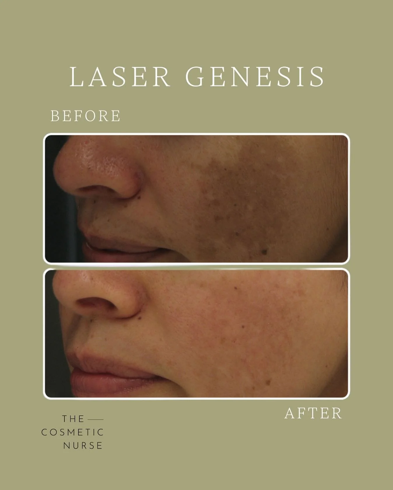 Treating pigmentation with Laser Genesis. 
A non-invasive treatment that targets redness, uneven tone and pigmentation &mdash; leaving your skin brighter, smoother, and more radiant after each session.

#LaserGenesis #SkinRejuvenation #PigmentationTr