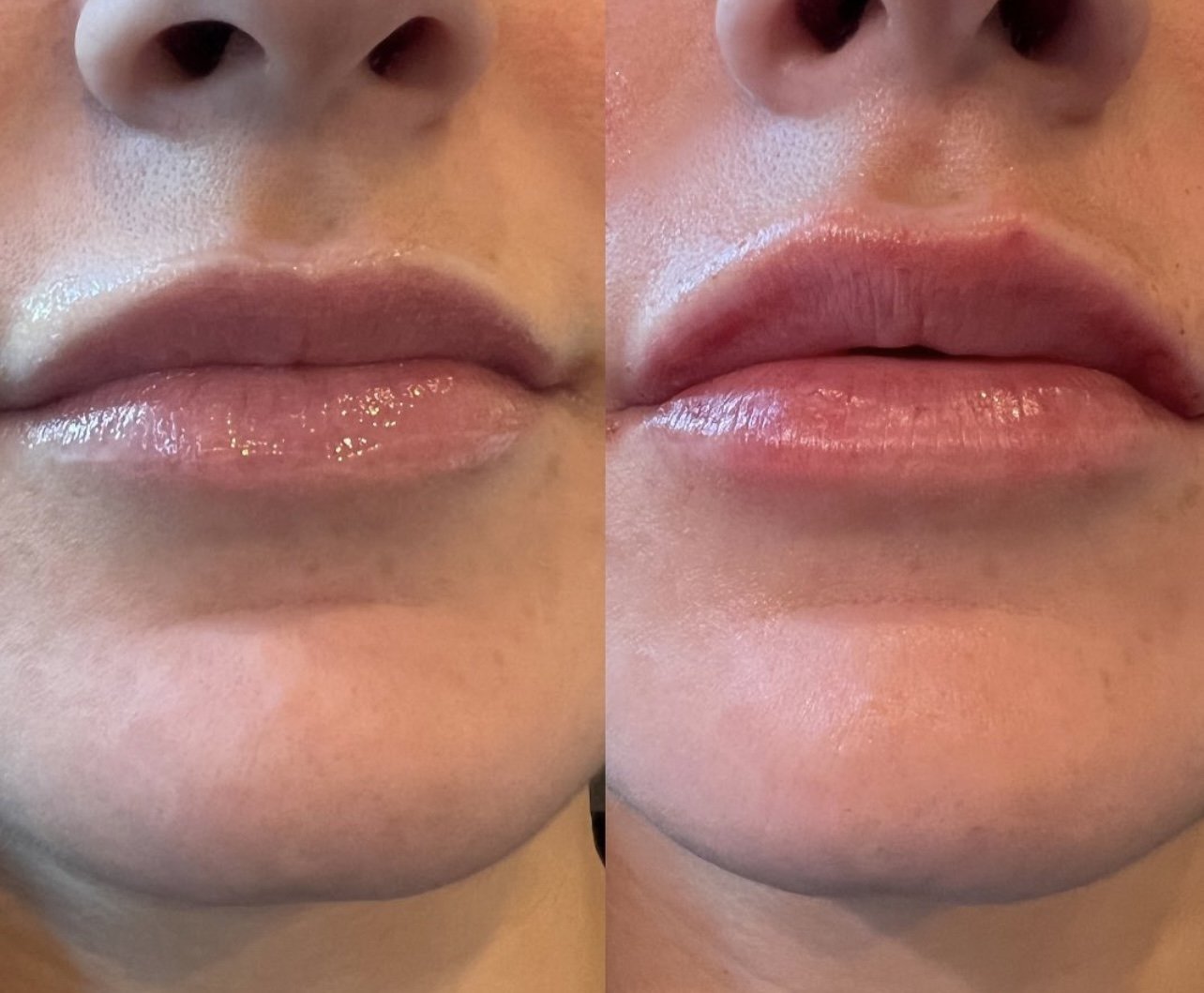 juicy lips always 🫦

take advantage of our lip filler special: Get 10% off when you buy 1/2 syringe, 20% off for 1 syringe, and a stunning 30% off when you buy 2 syringes. book at the link in bio (downtown only). 

injections by @injector.nikki 

#k