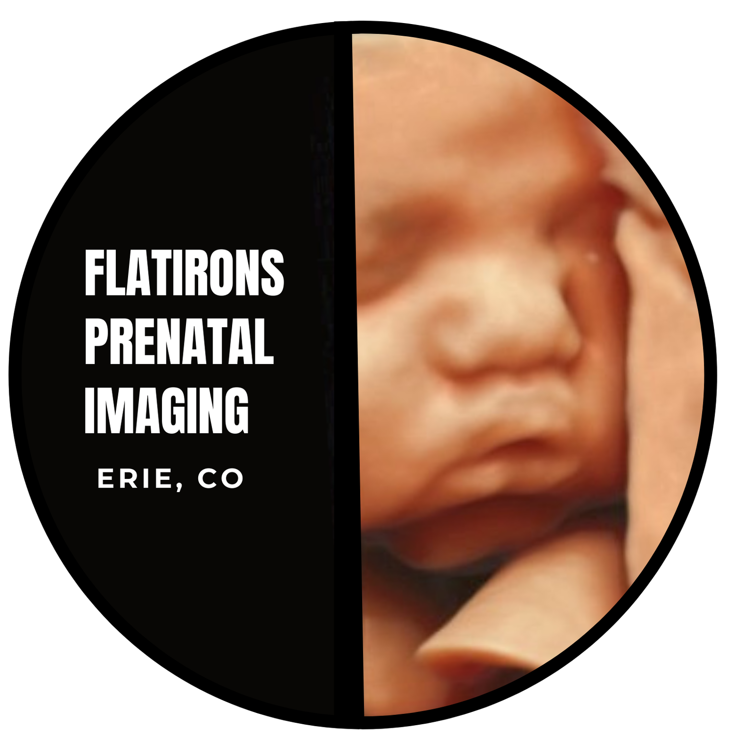 3D 4D Ultrasound Flatirons Prenatal Imaging