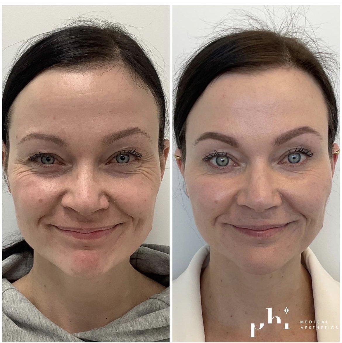 Full-Face-Filler-Botox14.jpg