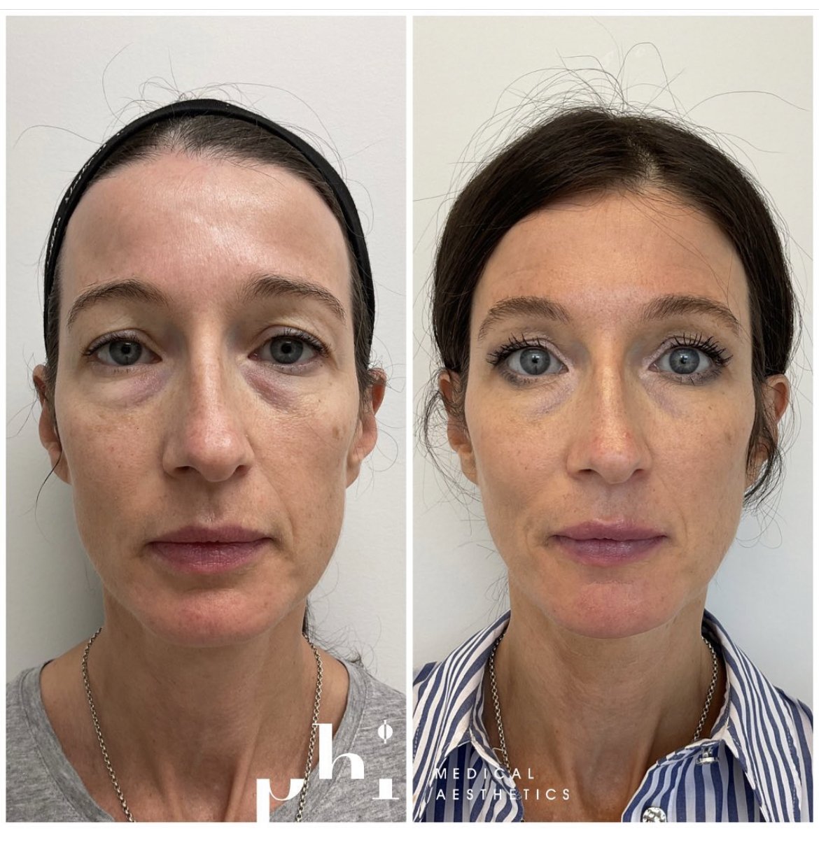 Full-Face-Filler-Botox16.jpg