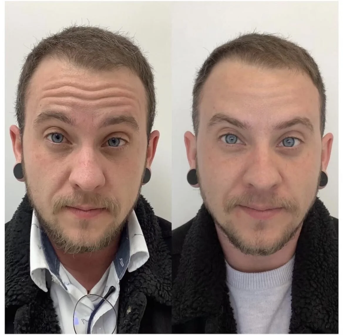 botox-PHI-Guys-8.jpeg