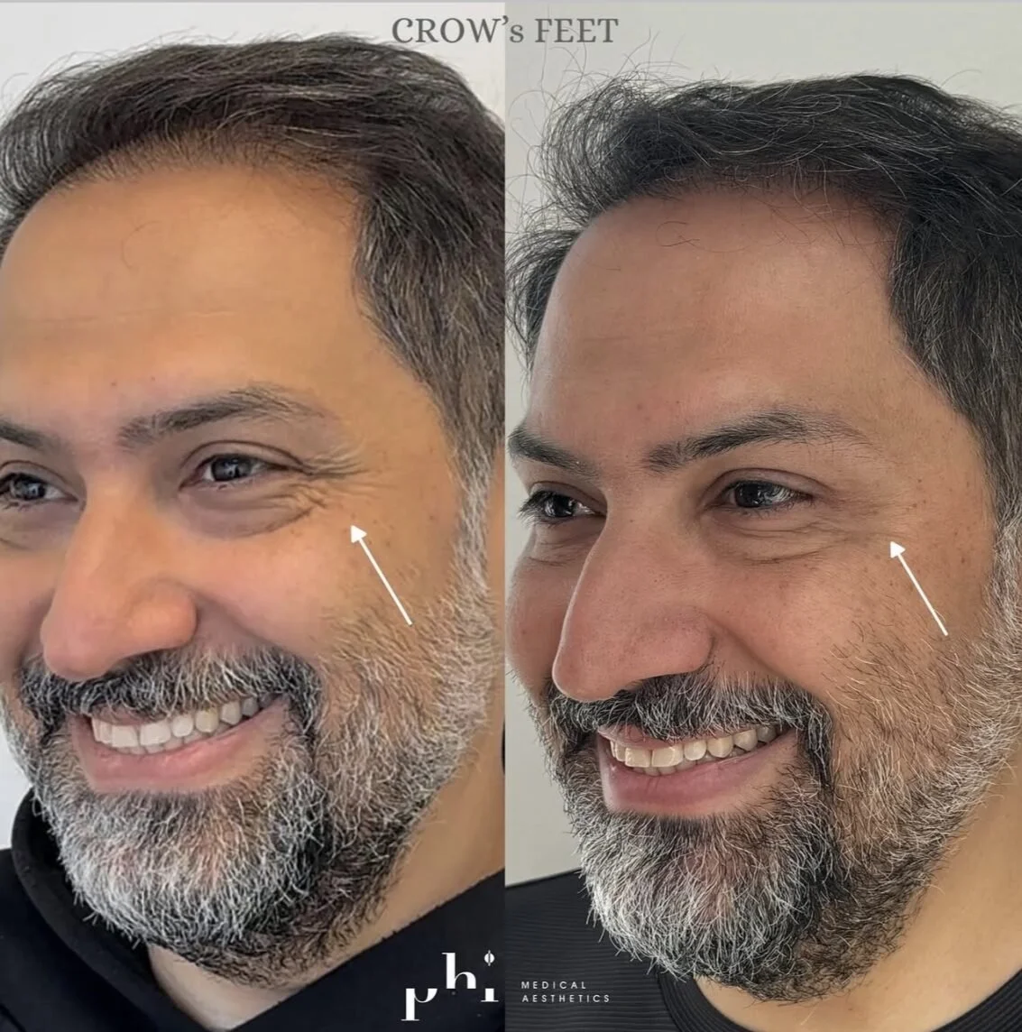botox-PHI-Guys-7.jpeg