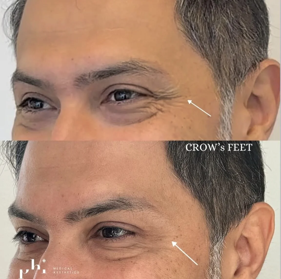 botox-PHI-Guys-6.jpeg