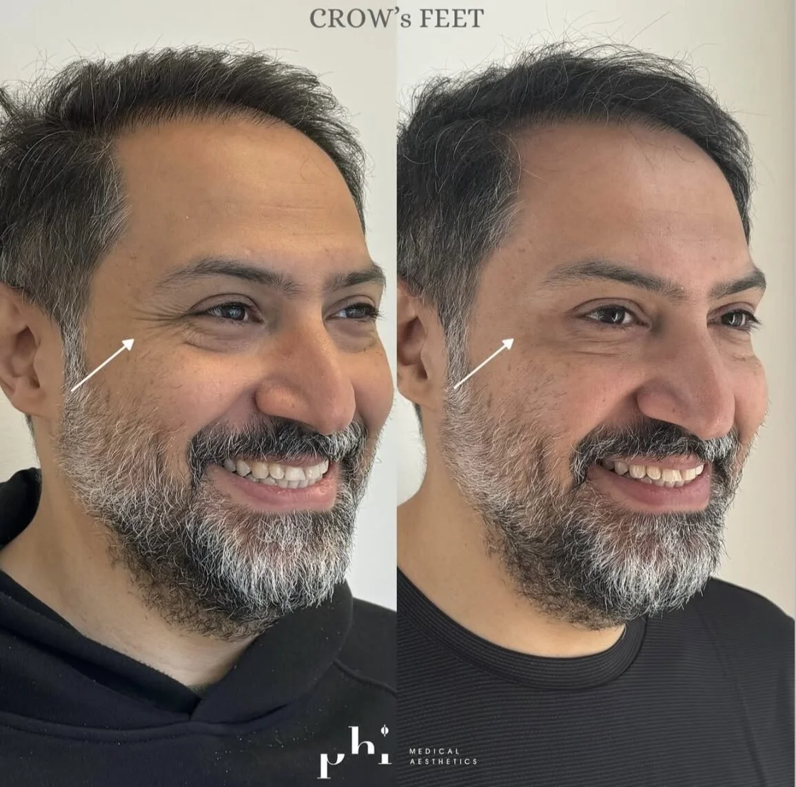 botox-PHI-Guys-5.jpeg
