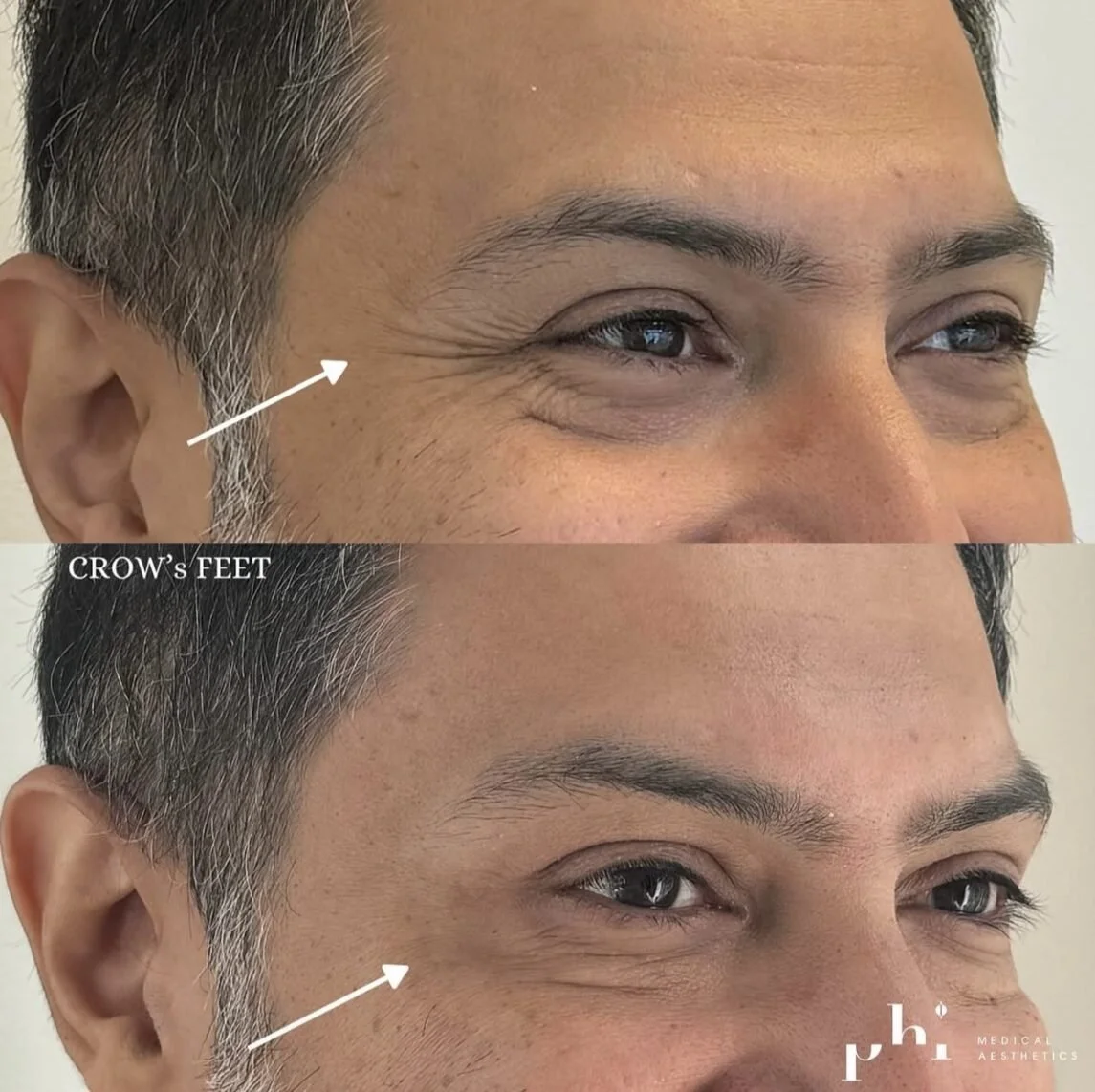botox-PHI-Guys-4.jpeg