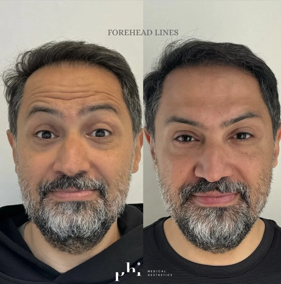 botox-PHI-Guys-3.jpeg