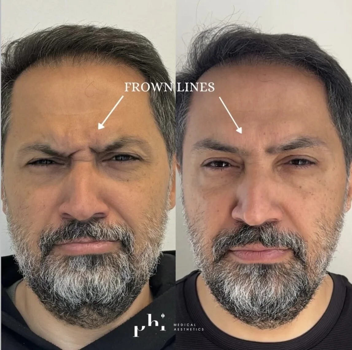 botox-PHI-Guys-2.jpeg