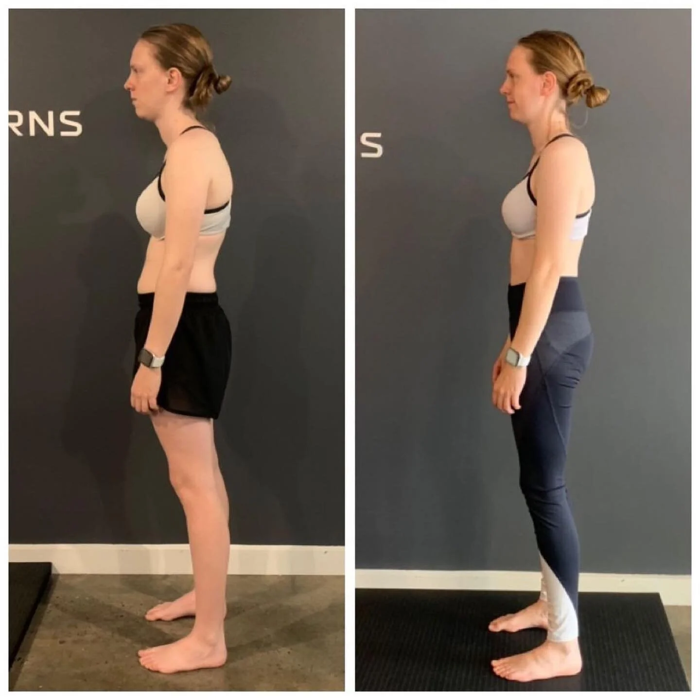 More great work from @jen.calleja
・・・
10 Hours of FP - Posture Improvement
Before: 01/08/22 
After: 17/10/22 
Before: 
❌Anterior pelvic shift 
❌Kyphosis 
❌Forward head posture 
❌Lack of abdominal pressure 
❌Hyperextended knees 
❌Lower back and leg