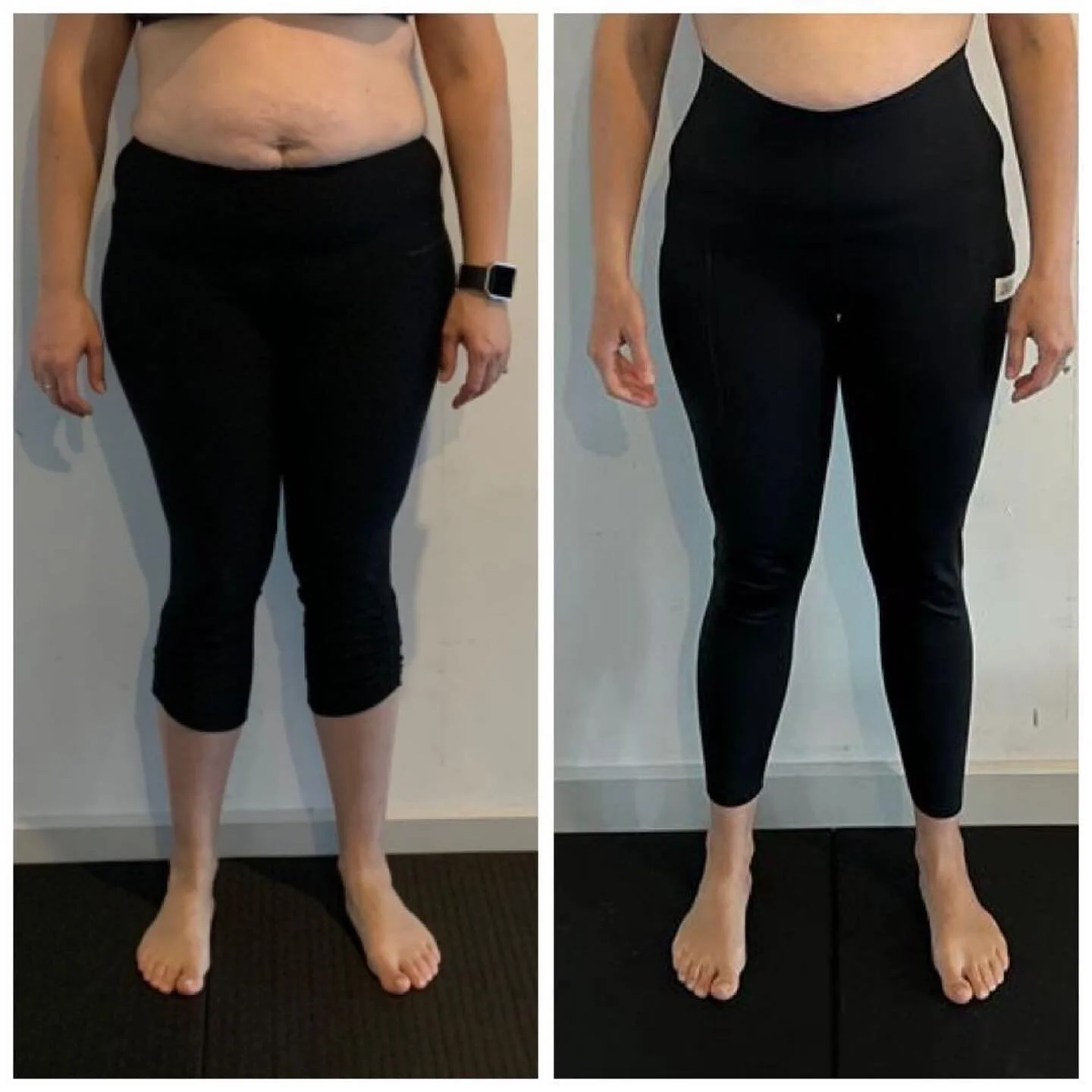 Some more great work from @jen.calleja
・・・
Knee Valgus Before/After Results
Before: December 2021 
After: October 2022 
Belinda came to me with a very hyperflaccid body and a lack of awareness on how to move her joints in space. Because of this and
