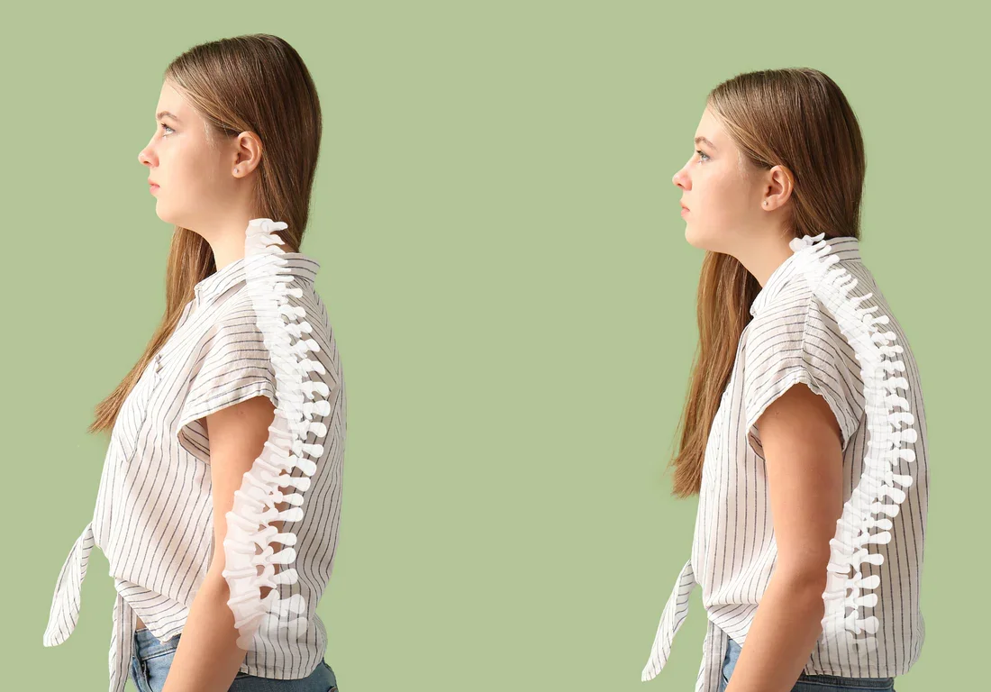Hunchback Posture: Causes, Symptoms, and How to Fix It for Long-Term Relief