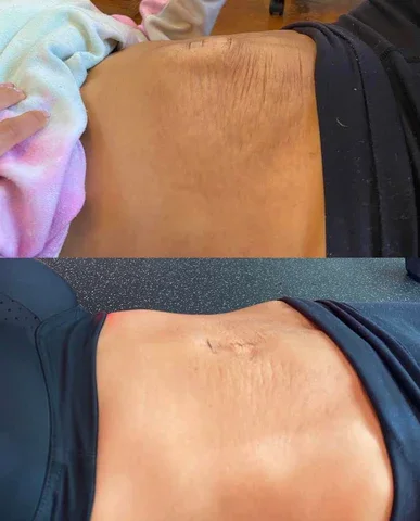 Everyday movement patterns that help prevent aggravation of diastasis recti