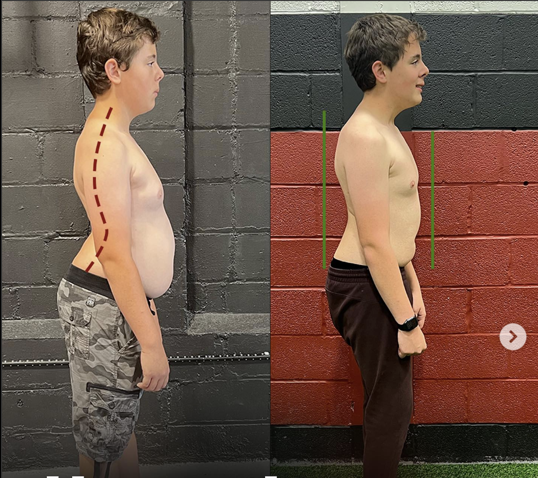 individual with hypermobility syndrome demonstrating poor posture and joint instability before targeted functional training