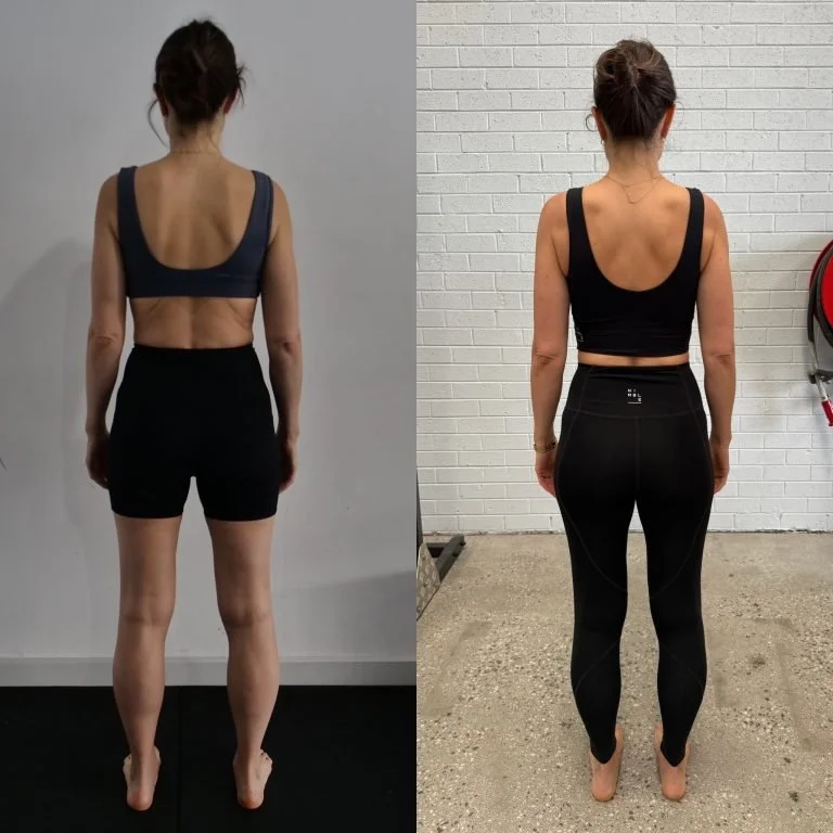 Comparison of scapular winging before and after Functional Patterns exercises to correct shoulder blade pain and improve posture