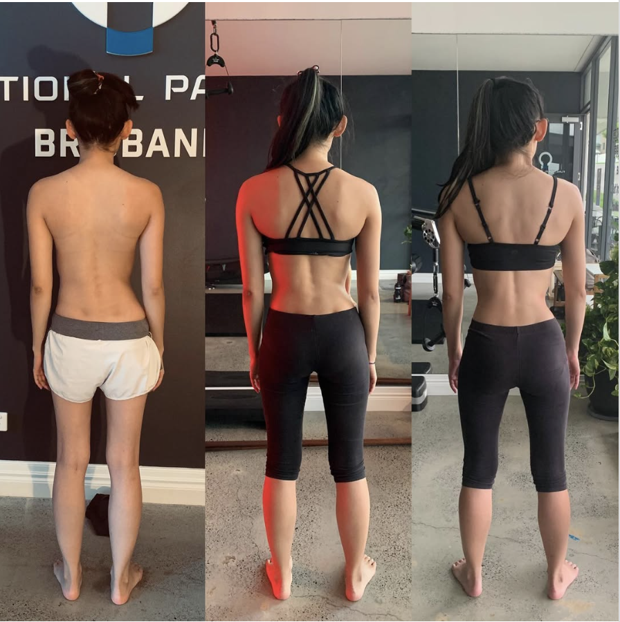 Postural assessment showing spinal asymmetry commonly associated with idiopathic scoliosis