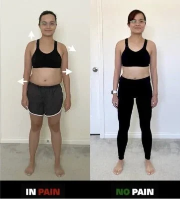 jennifer-scoliosis.jpeg
