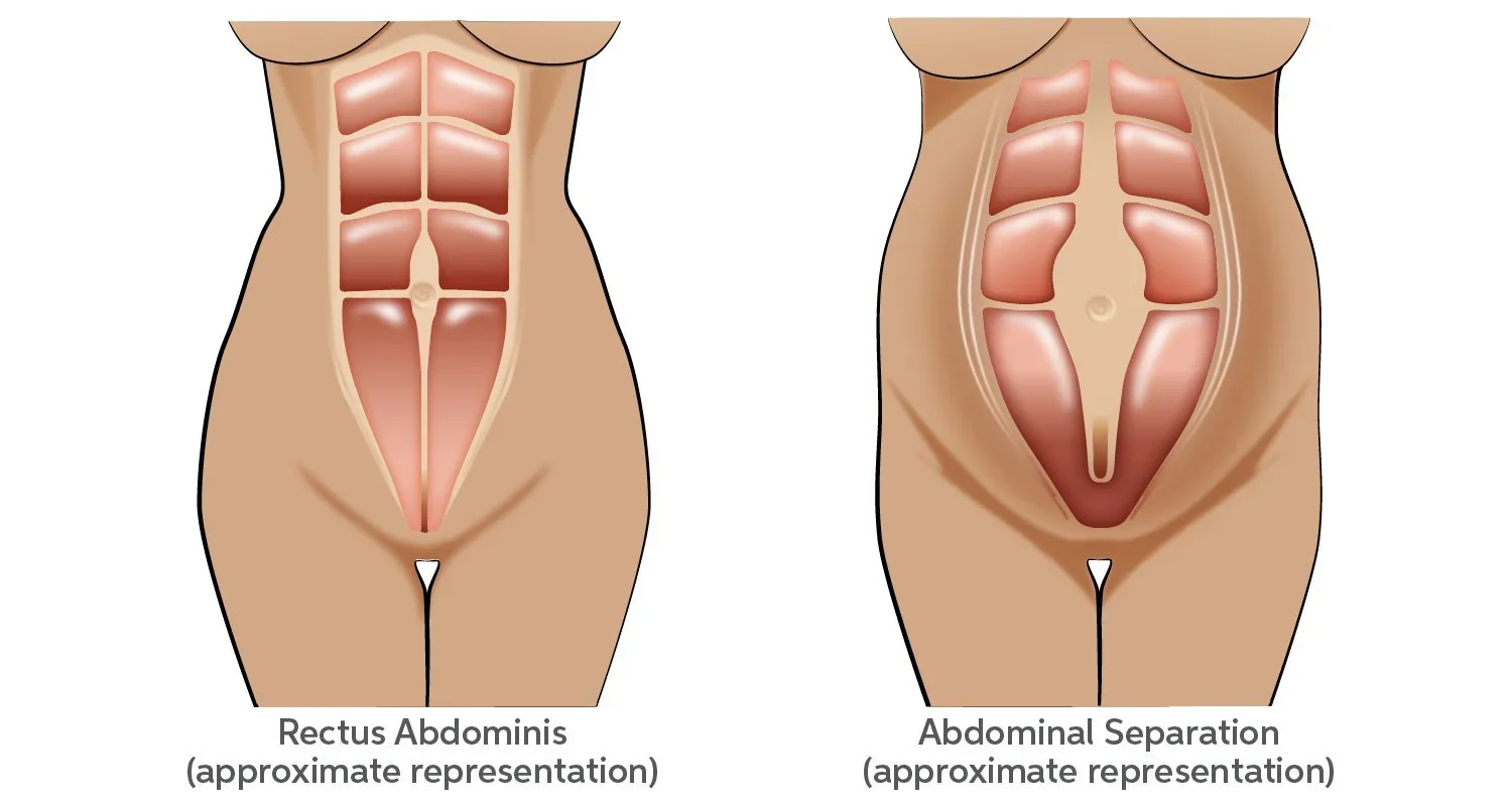 Diagram showing diastasis recti abdominal separation in postpartum women