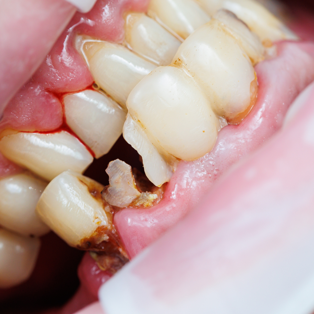 Tips for Preventing Tooth Enamel Erosion