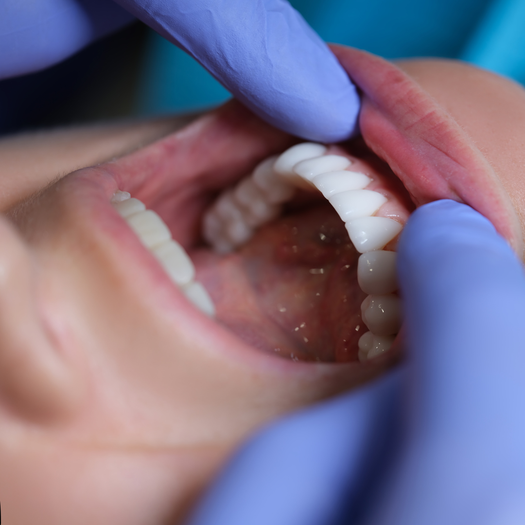 Achieve a Perfect Smile with Composite Veneers: Everything You Need to Know