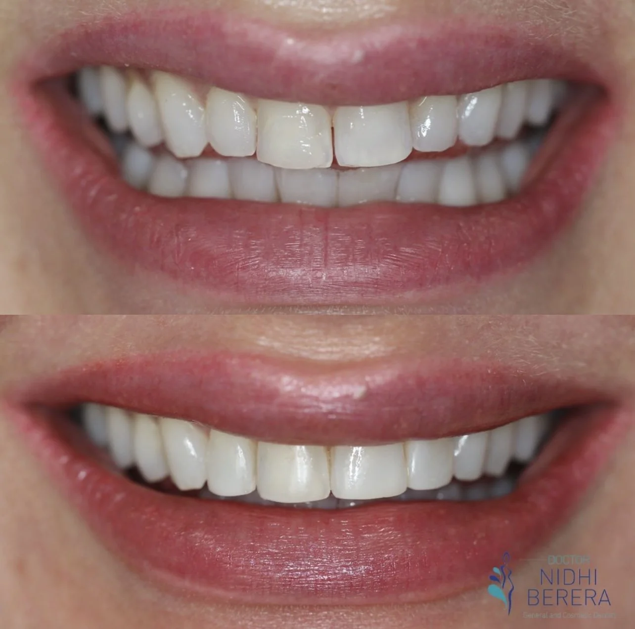 The Process and Benefits of Dental Bonding