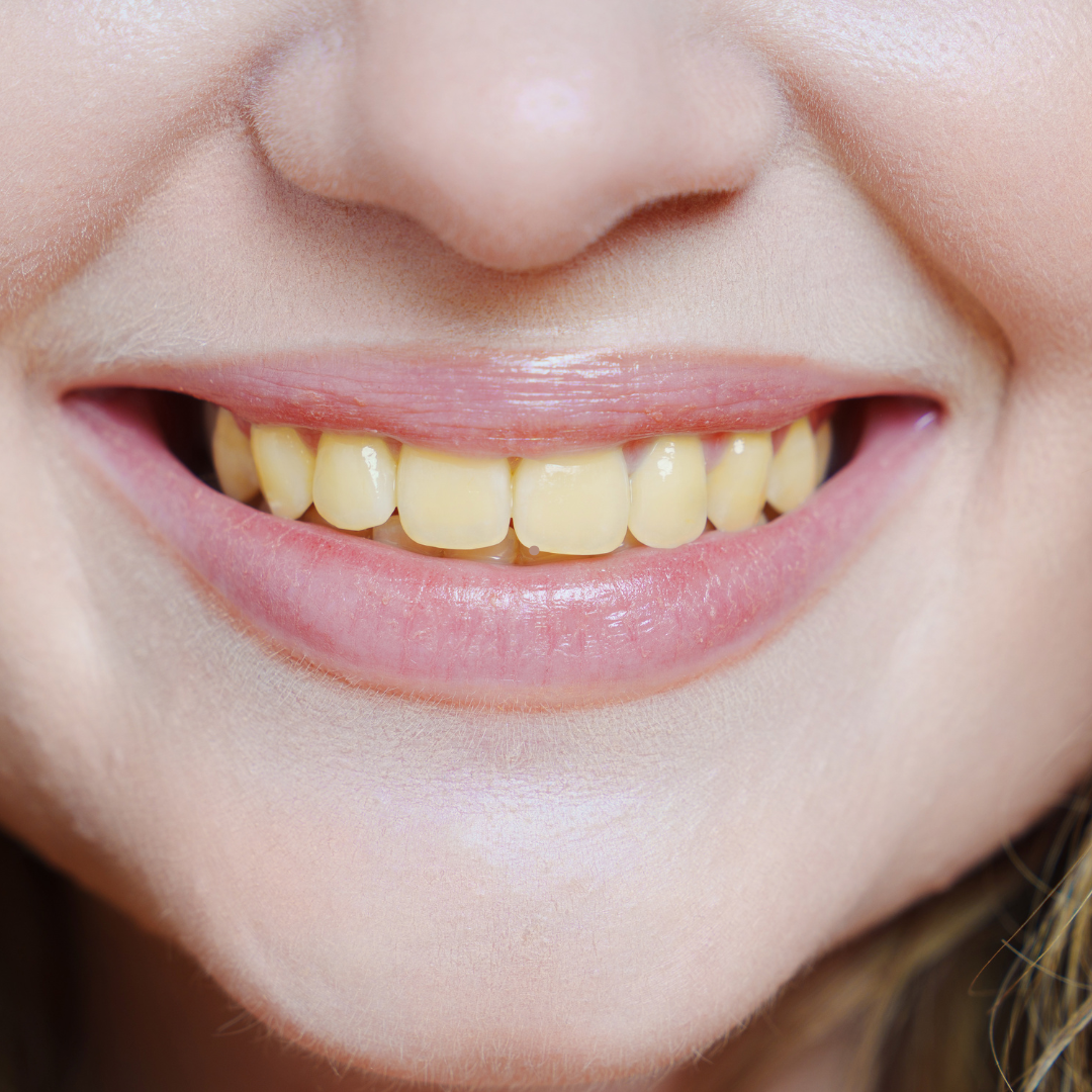 Why Are My Teeth Yellow Even Though I Brush?