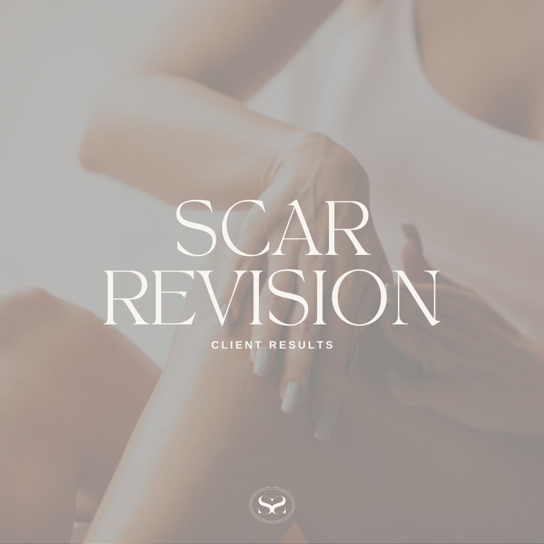 SCAR REVISION

We are so happy with these results. This client received a double hip replacement in 2022 which increased her mobility but left her with scars she wanted gone. 

Through a microneedling technique, we infused the area with a serum that 