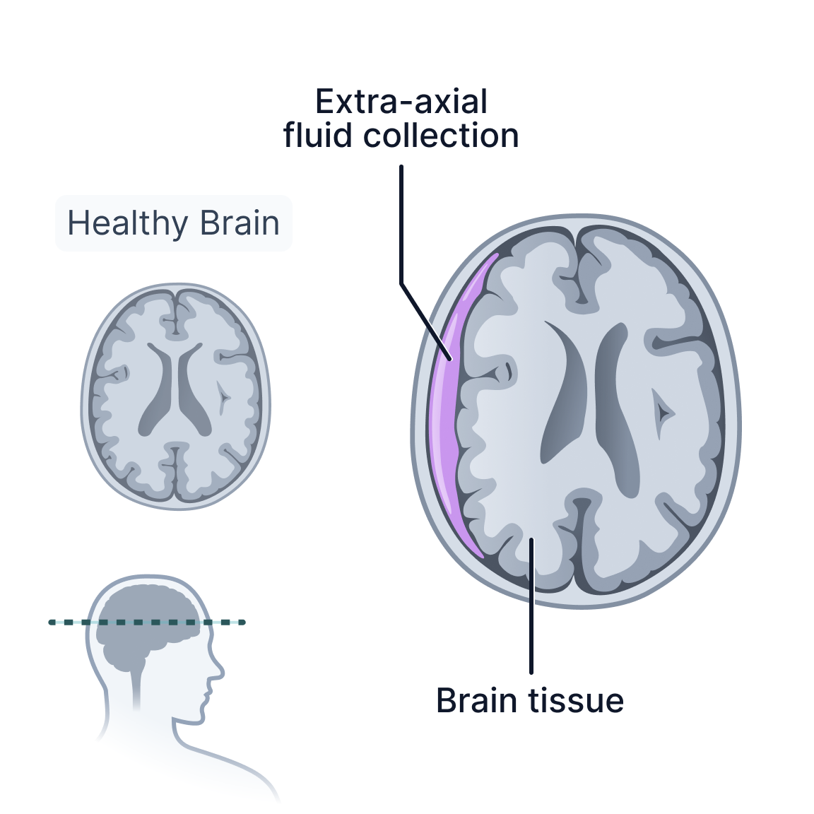 Extra-Axial Fluid Collection.png
