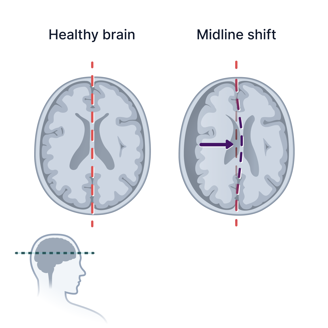 Midline Shift.png