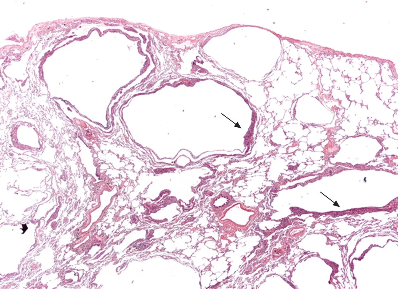 Histological slide showing sections of cystic lung tissue. Arrows indicate specific regions of interest.