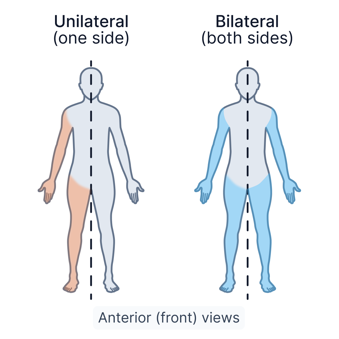 Unilateral bilateral.png