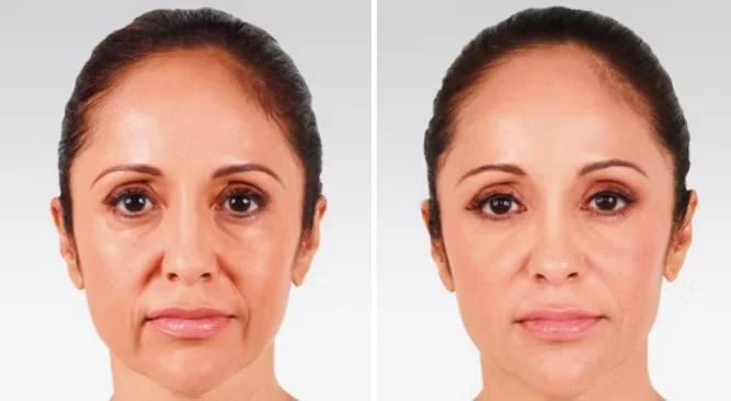 What's The Best Method of Non-Surgical Facelifts?