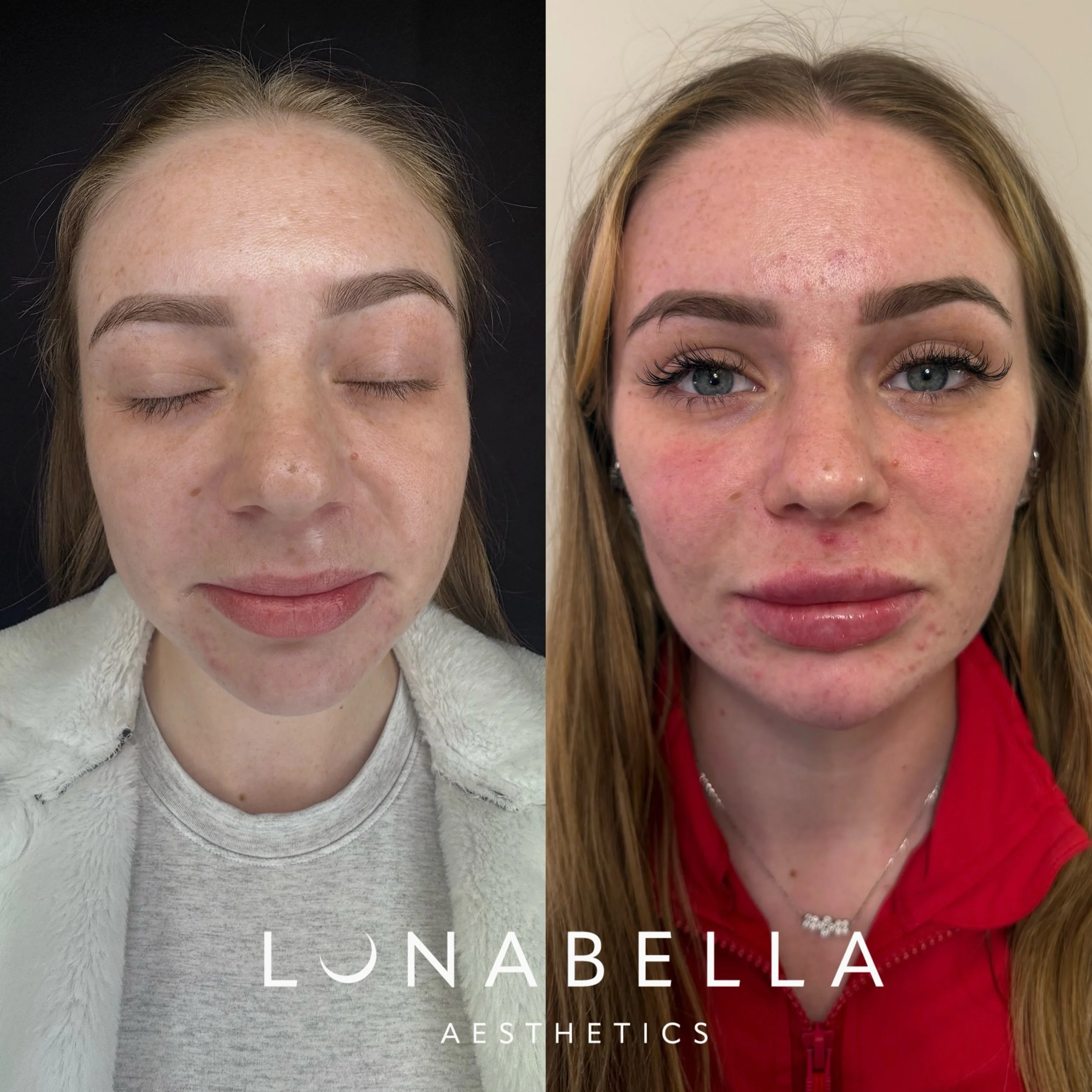 ✨Loving these natural facial balancing results ✨

Enhancing your natural beauty while preserving the harmony that makes you uniquely you. Soft, balanced, and refined results that never look overdone. 🤍

&mdash;

✨Amando estos resultados naturales de