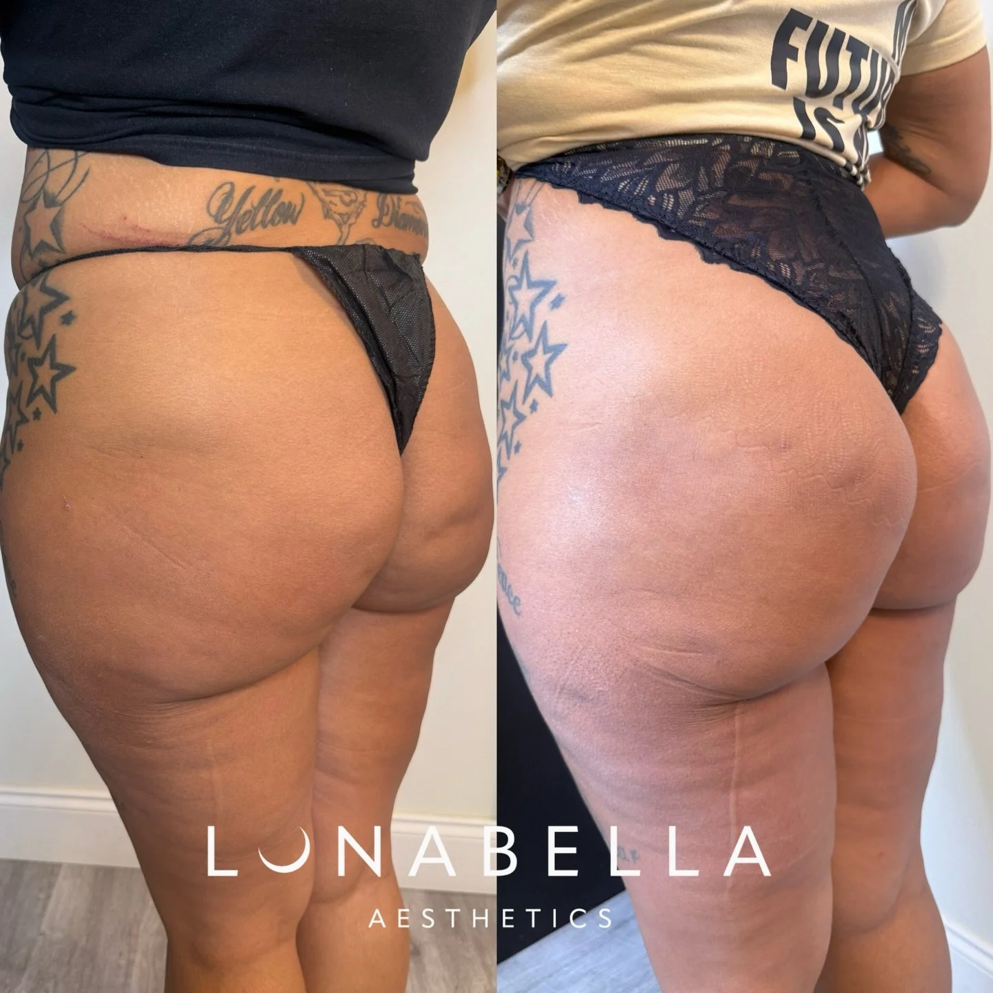 ✨ 1 Month Post Treatment Results ✨

This beautiful transformation is 1 month after I-Cell + I-Lift using our I-Laser Endolift technology, targeting skin tightening, contouring, and visible improvement in cellulite.

For optimal results, we combined t
