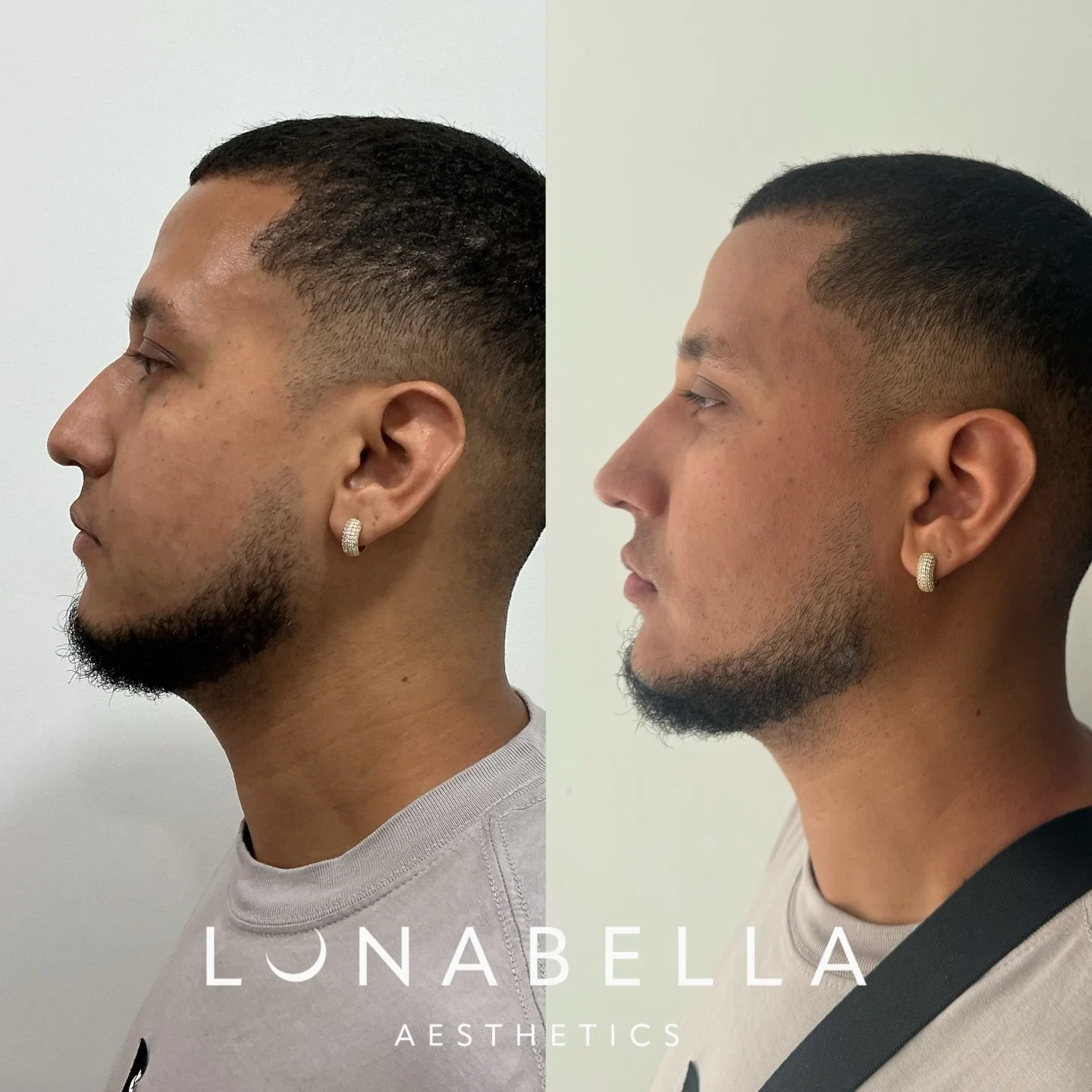 ✨Aesthetics isn&rsquo;t just for women and men benefit too.

Small, subtle changes can define, refresh, and elevate your look without looking &ldquo;done.&rdquo;

Because the best results don&rsquo;t change you&hellip; they enhance you.

📍 Lunabella