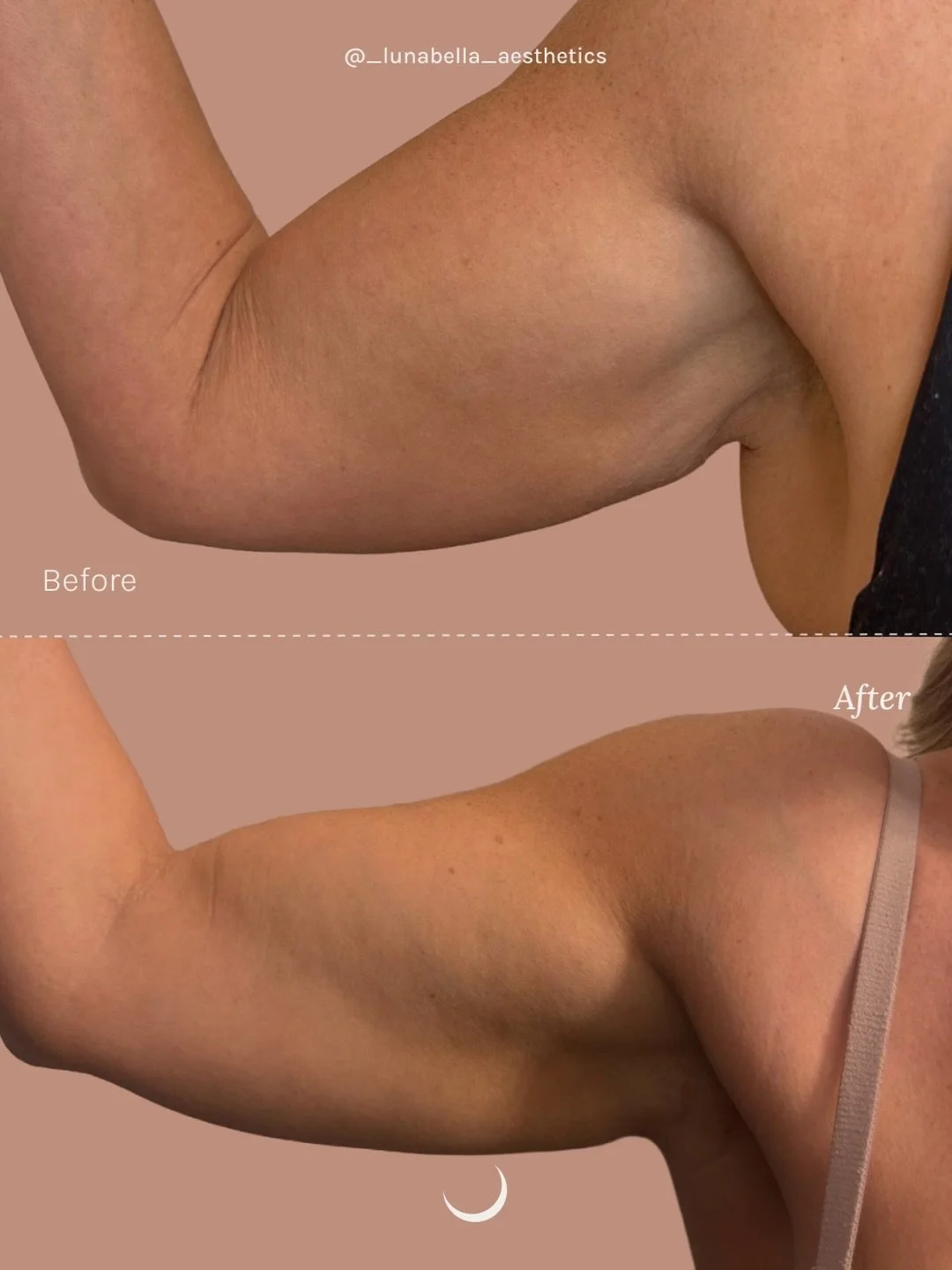 ✨ Tighten &amp; Sculpt Without Surgery ✨

Endolift for the arms helps tighten loose skin, improve contour, and stimulate collagen for long-lasting results with minimal downtime.

This advanced laser treatment can also be used on the:
✔️ Abdomen
✔️ In