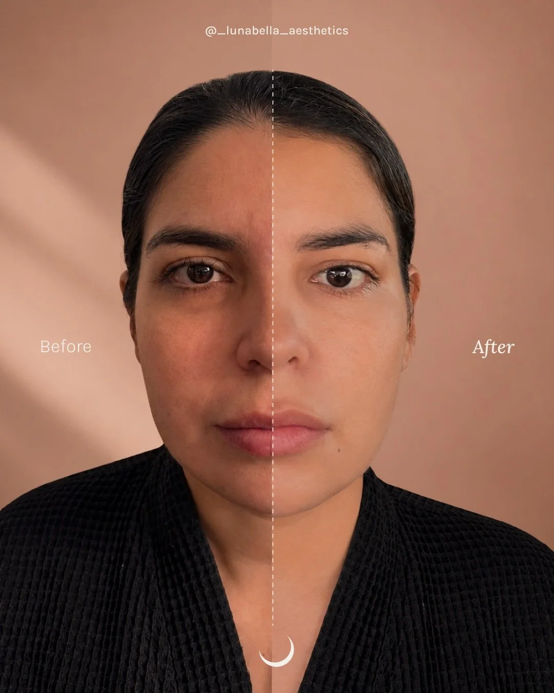 ✨ Natural Results Start With the Right Plan 
.
Every face is different, and every treatment plan should be too. 🤍
.
For this patient, we created a customized combination treatment plan using:
✔️ Ultherapy Prime to lift and stimulate collagen at the 
