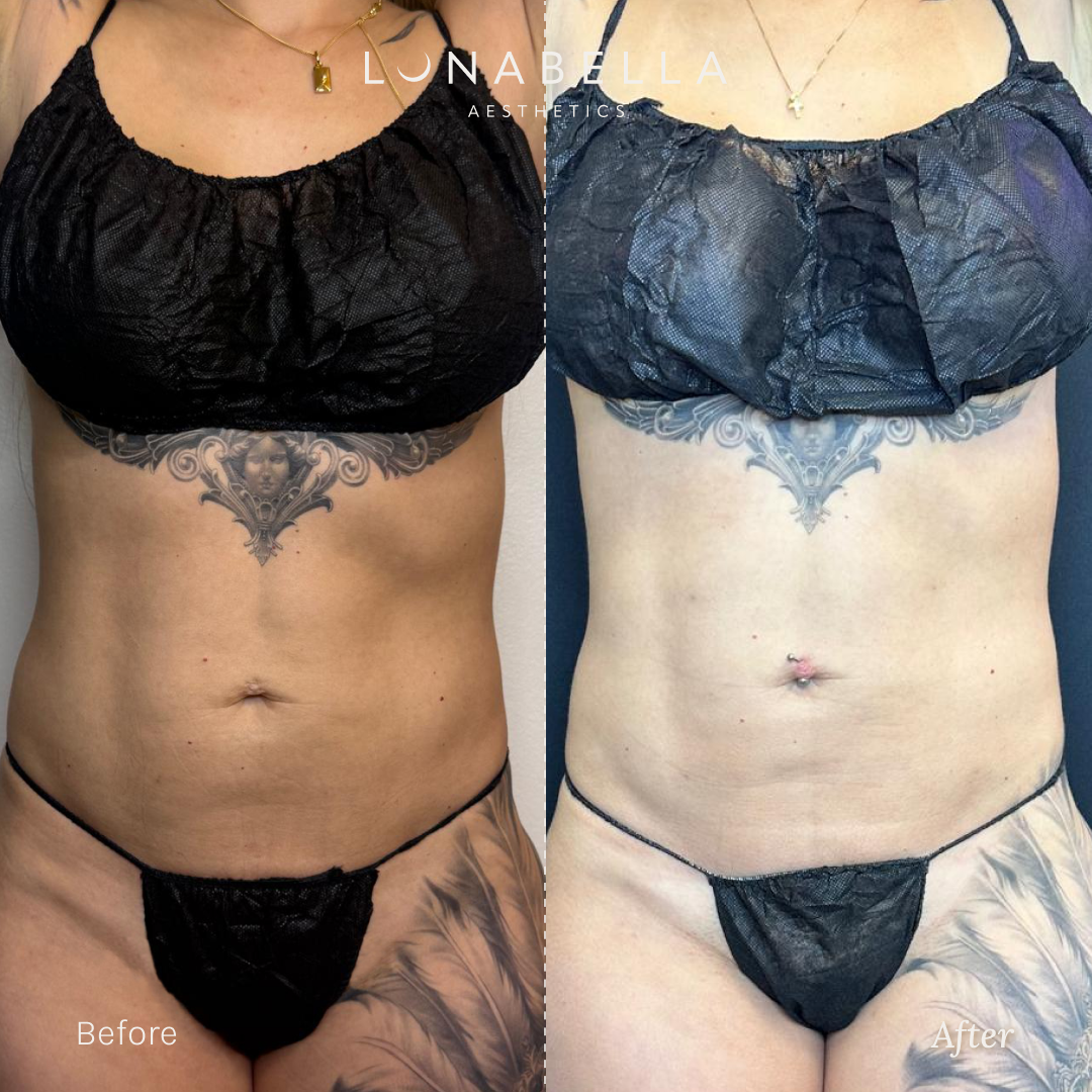 BeforeAfter_Endolift_1.png