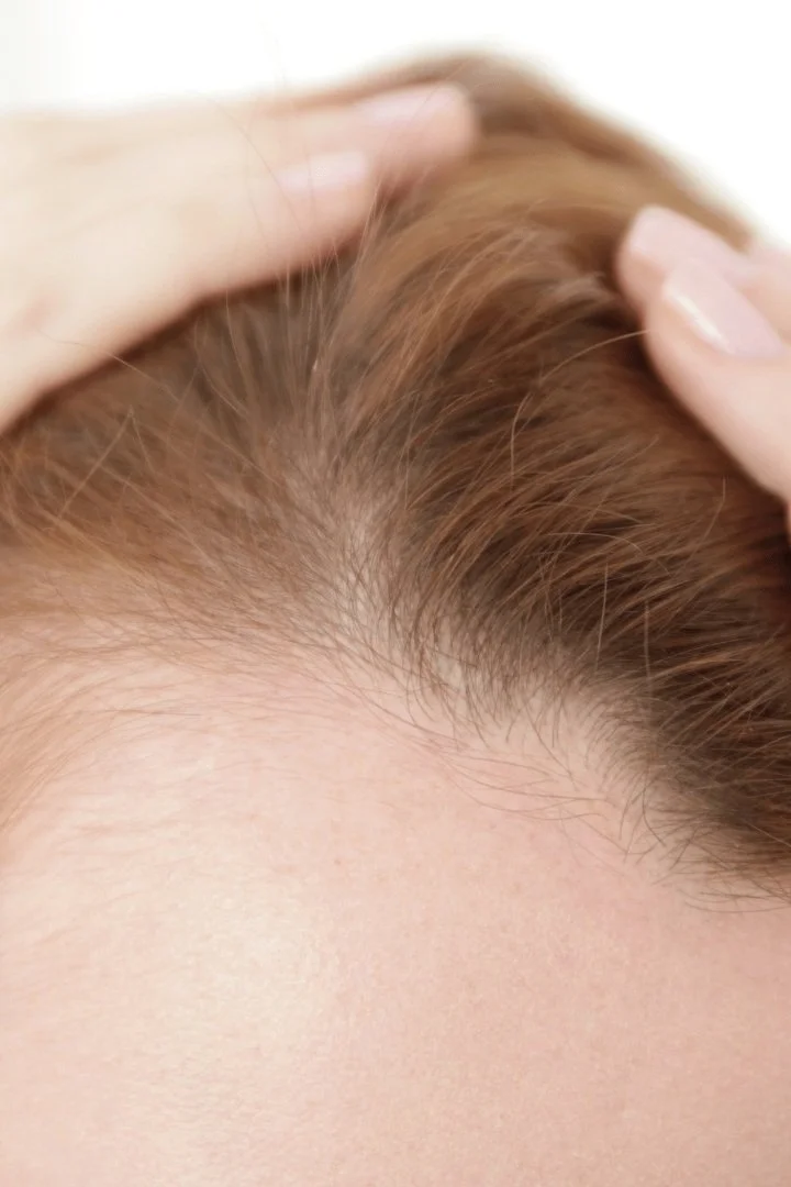 hair loss treatment tampa