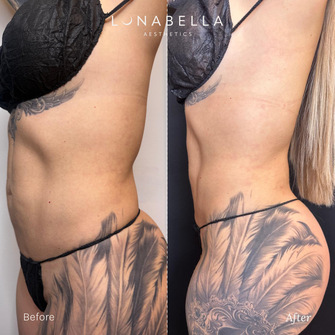 BeforeAfter_Endolift_2.png