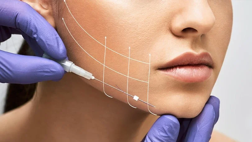 Close-up of a woman receiving a cosmetic procedure on her jawline with dotted lines and arrows indicating a lifting or contouring technique, while wearing a glove and using a syringe.