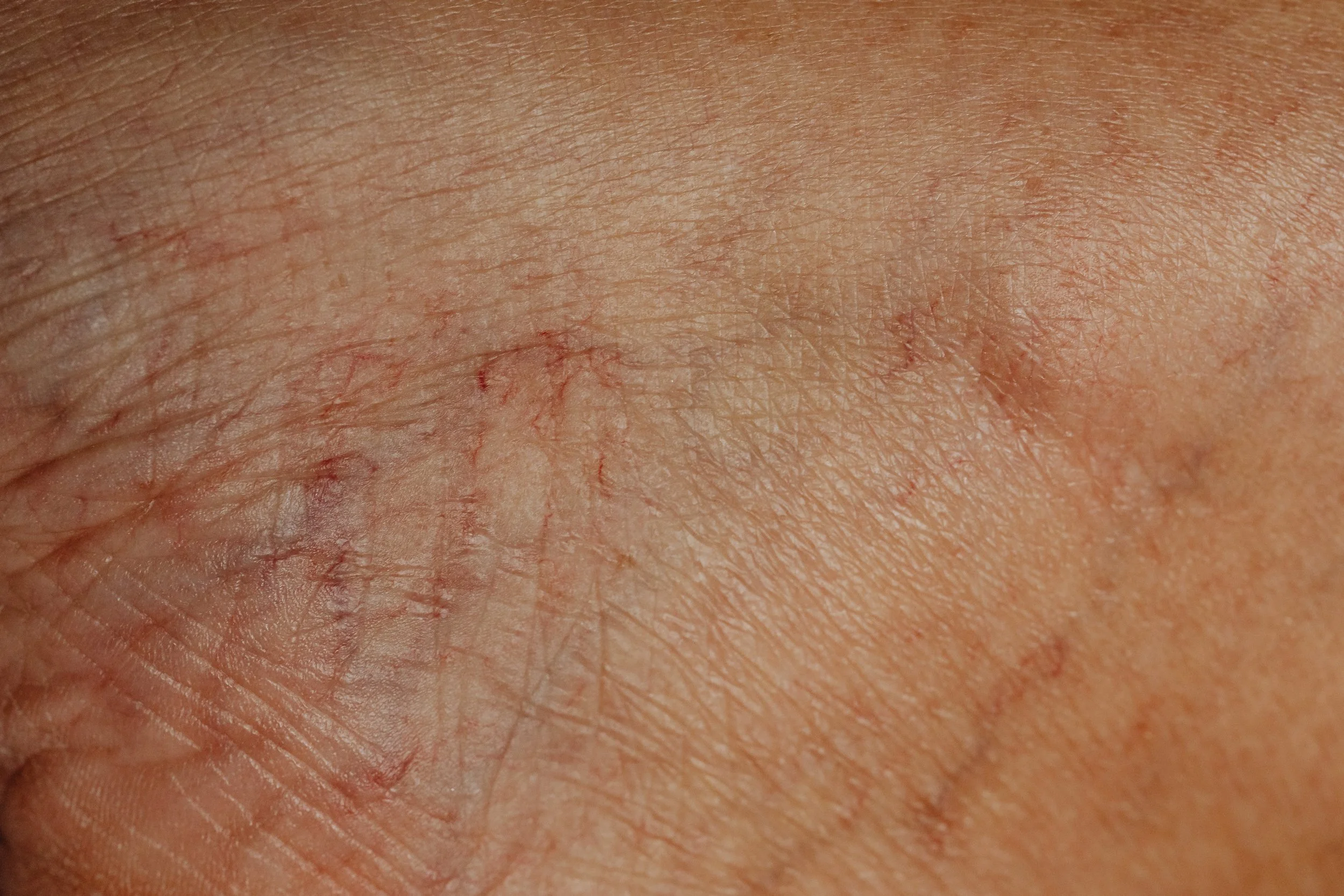 Close-up image of skin with visible fine lines, redness, and small blood vessels.