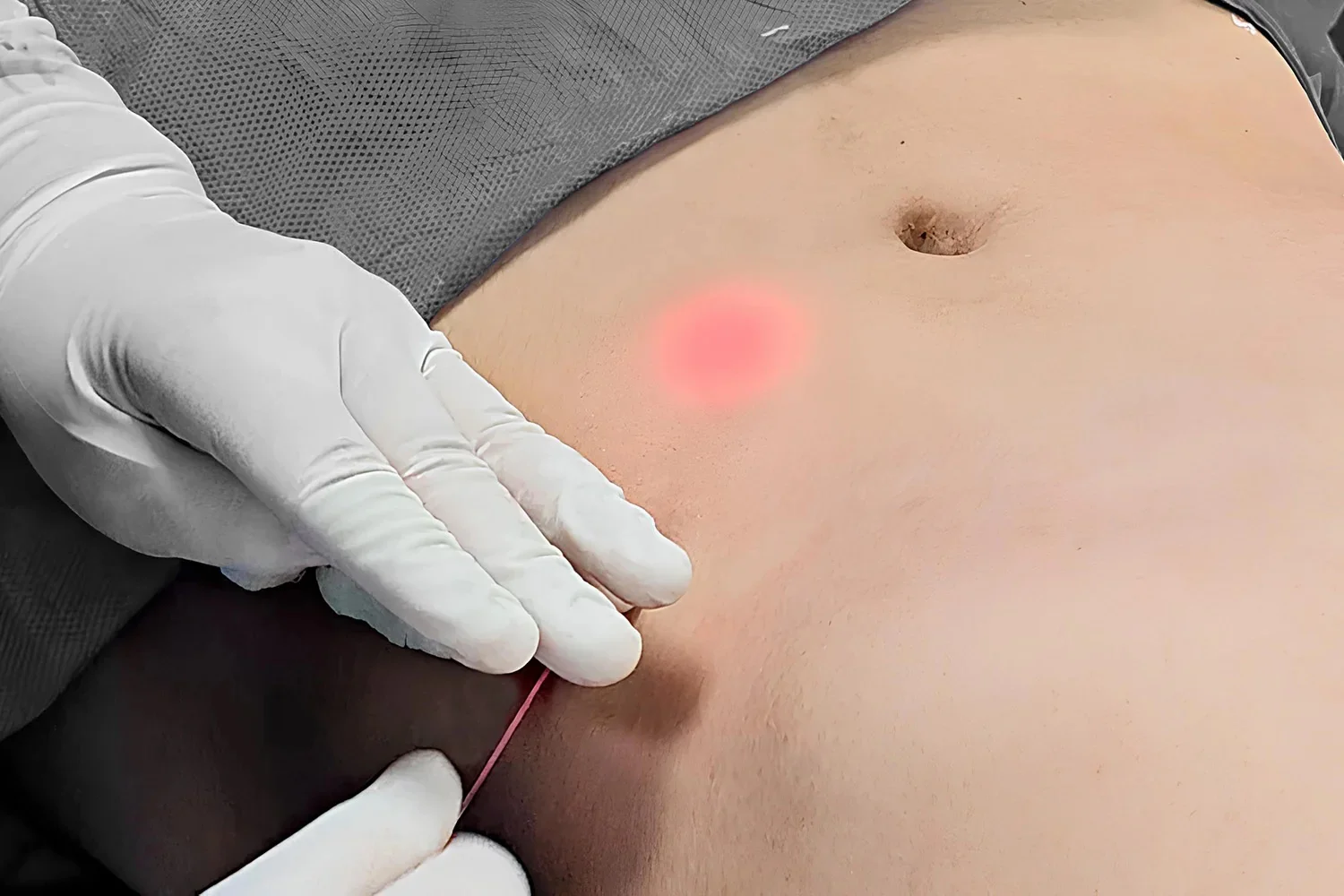 A medical professional in white gloves inserting a needle into a patient's abdomen during a procedure, with a red-lit area indicating the target site.