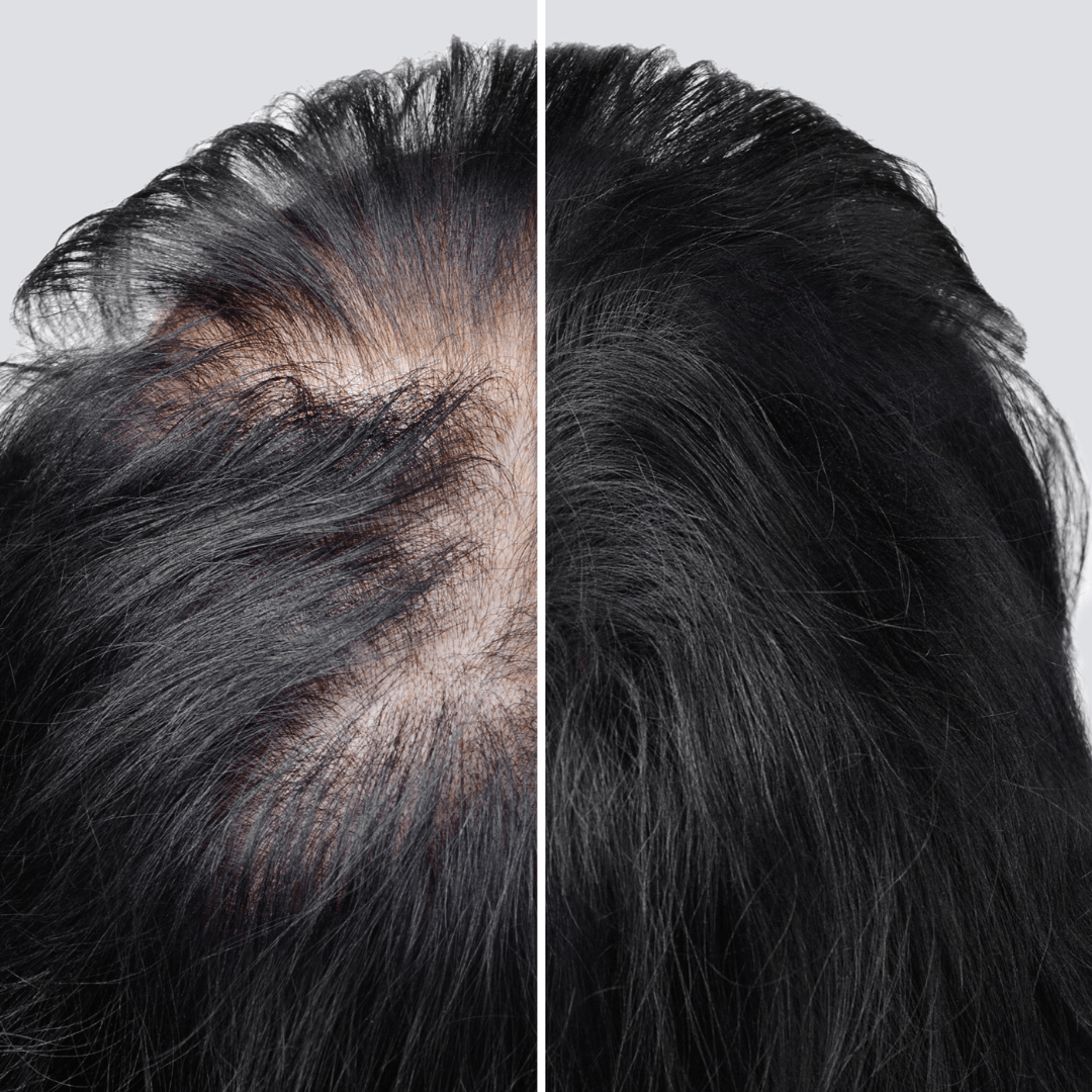Side-by-side comparison of a person's scalp before and after hair treatment showing significant improvement in hair density and coverage.