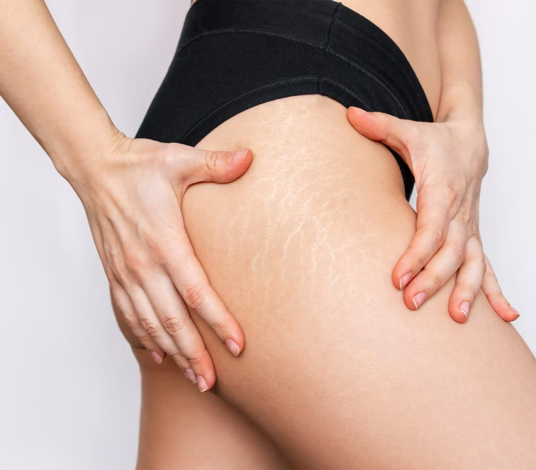laser for stretch marks